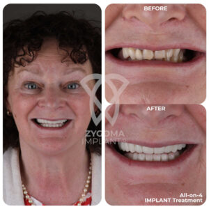 All-on-4 Dental Implants before and after