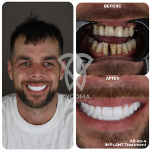 All-on-4 Dental Implants before and after