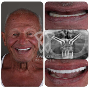 All-on-4 Dental Implants before and after