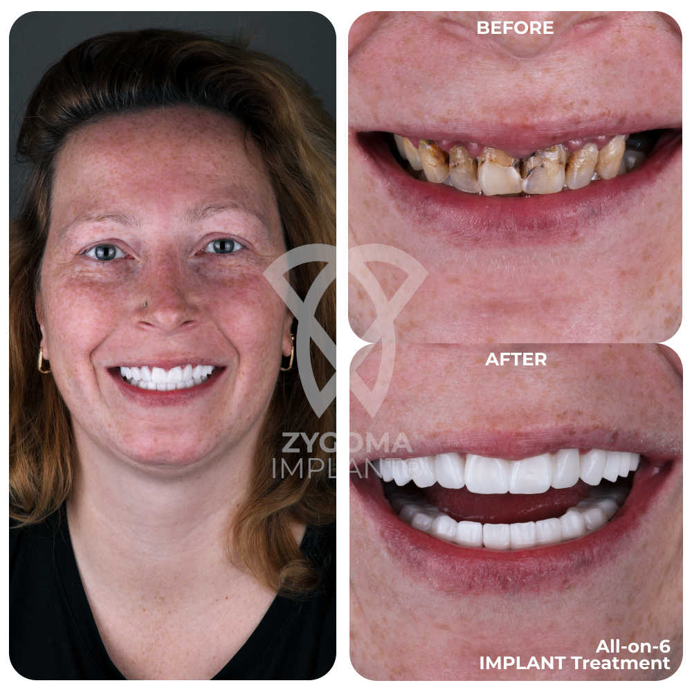 All-on-4 Dental Implants before and after