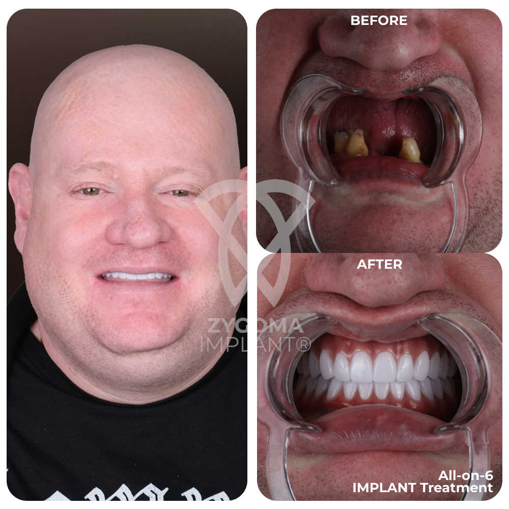 All-on-4 Dental Implants before and after