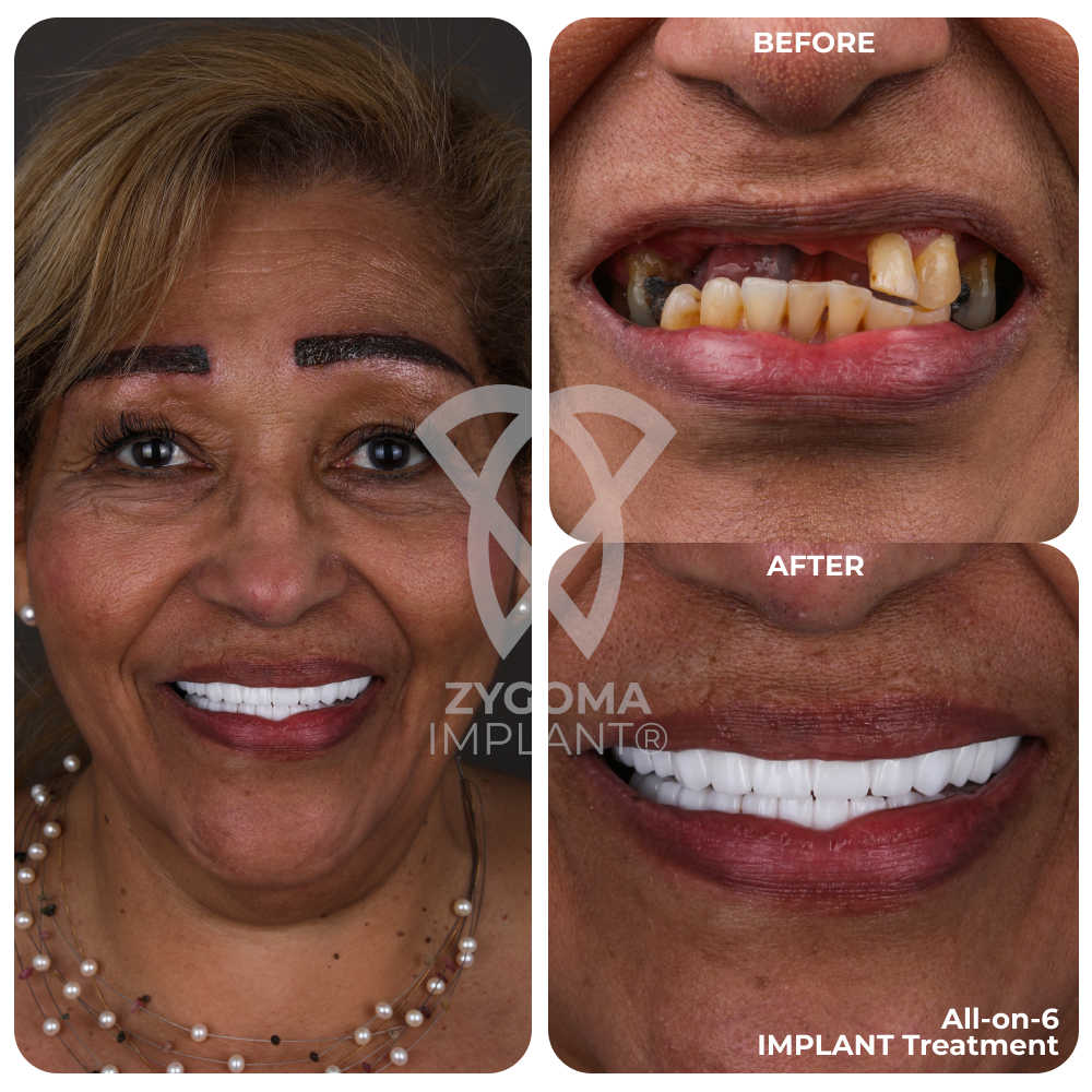 All-on-4 Dental Implants before and after