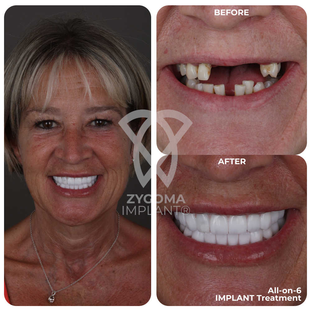 All-on-4 Dental Implants before and after