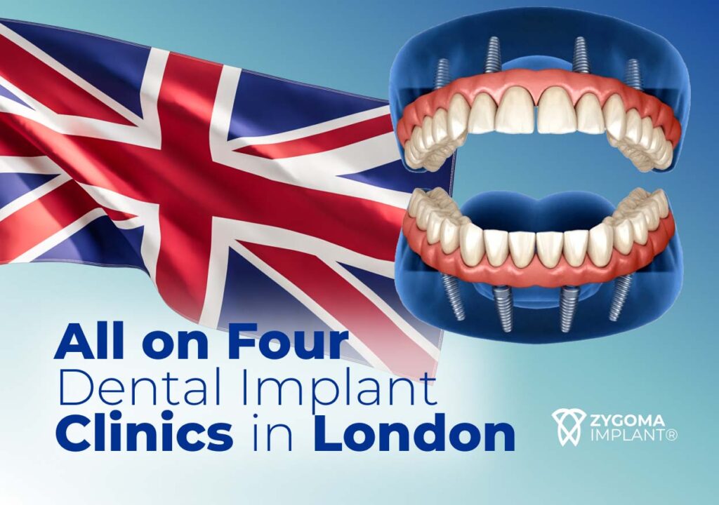 All on Four Dental Implant Clinics in London