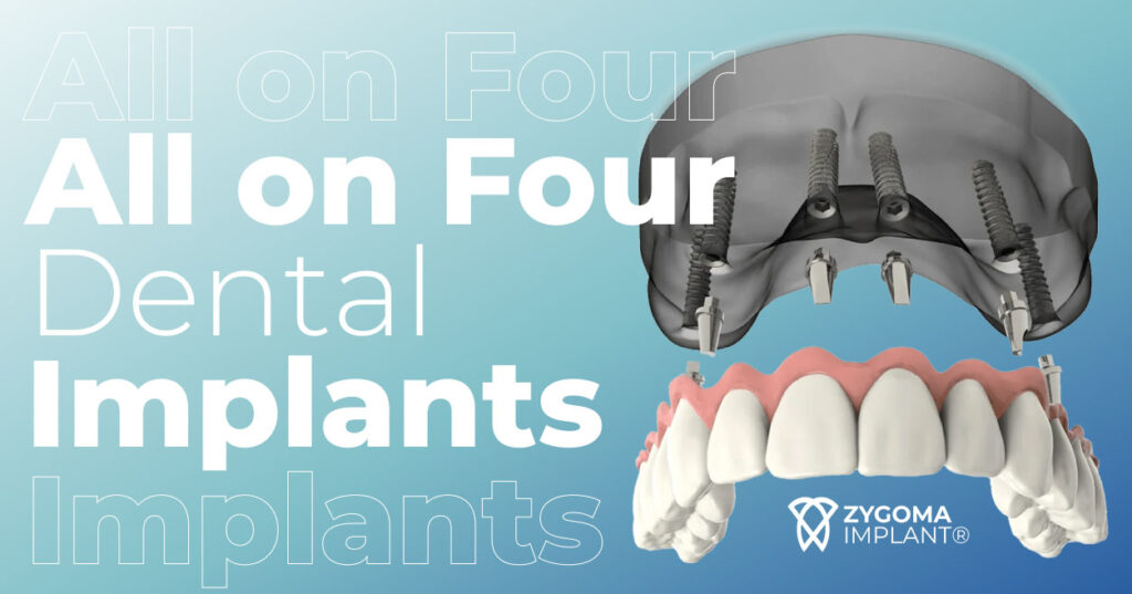 All on four dental implant