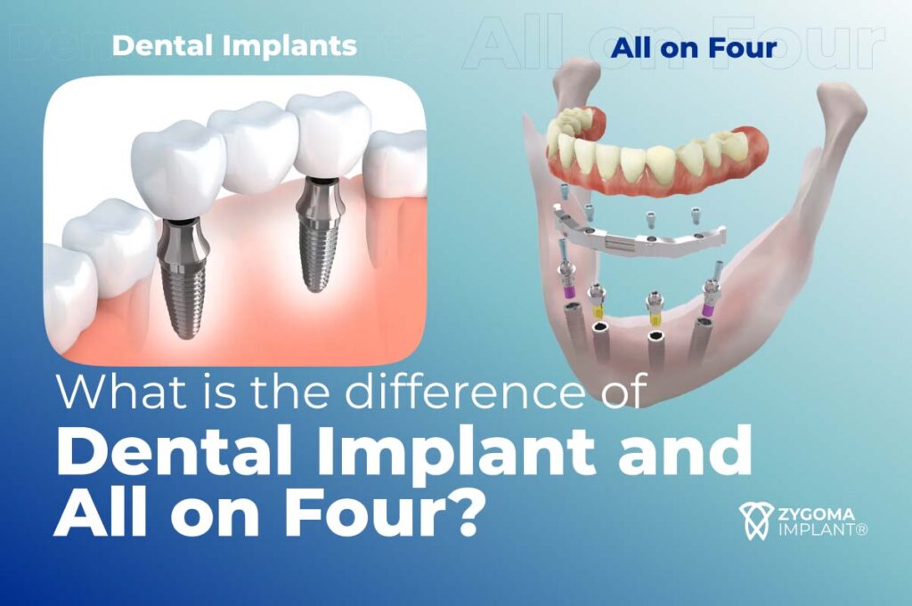 What is the defference of dental implants and all on four