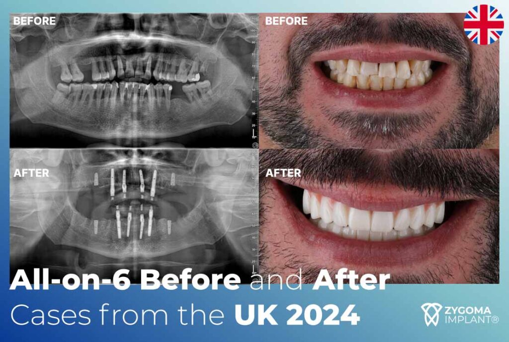 All-on-6 Before and After Cases from the UK 2024