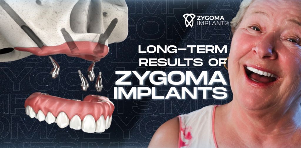 Long-term results of Zygoma Implants