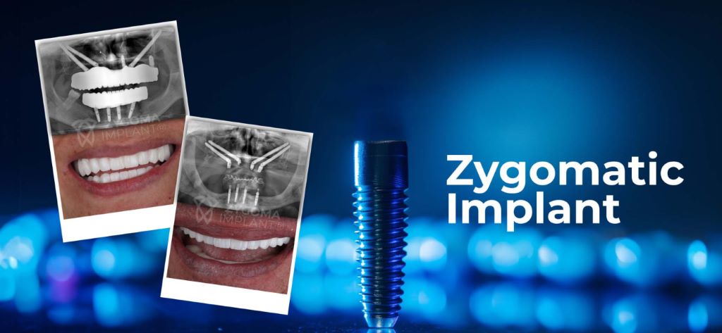 Zygomatic implants