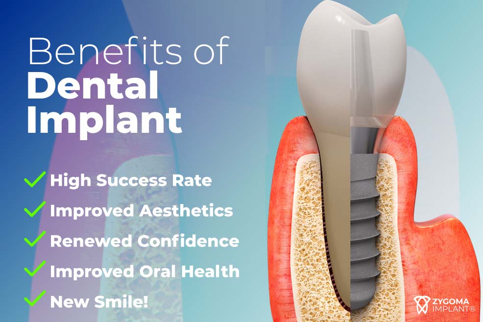 Benefits of dental implants