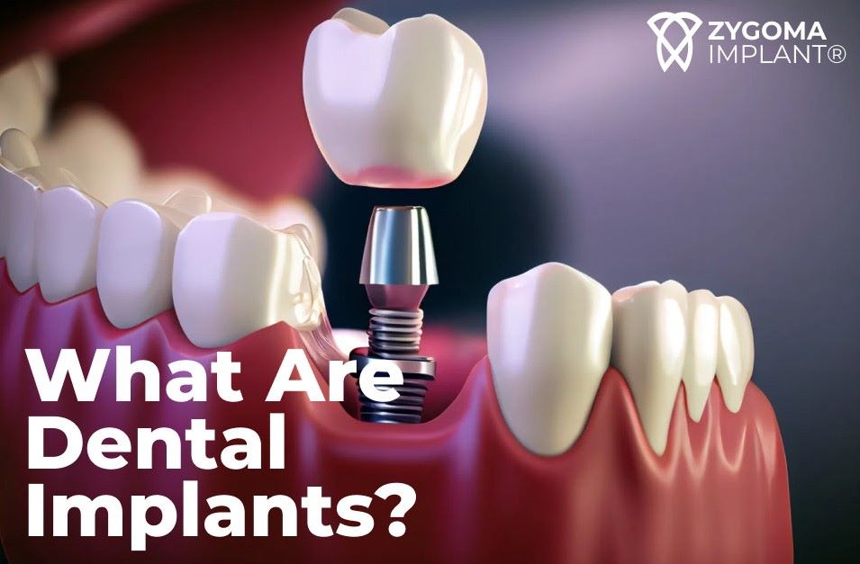 Display of dental implant